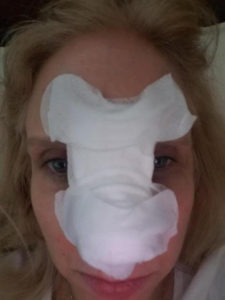 Photo of bandages required after Mohs surgery on the nose