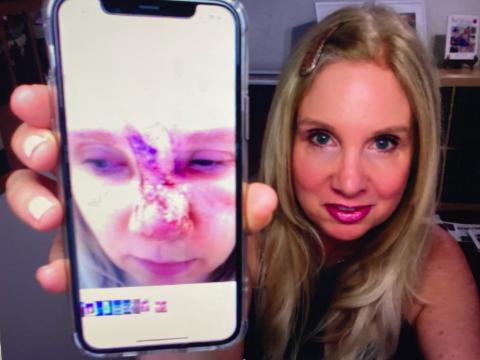girl holding up cell phone with a photo of mohs surgery on her nose