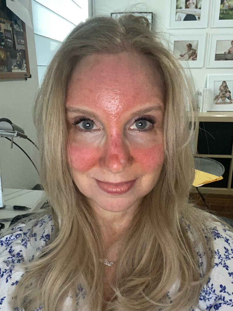 photo of woman with red face due to photodynamic therapy 
